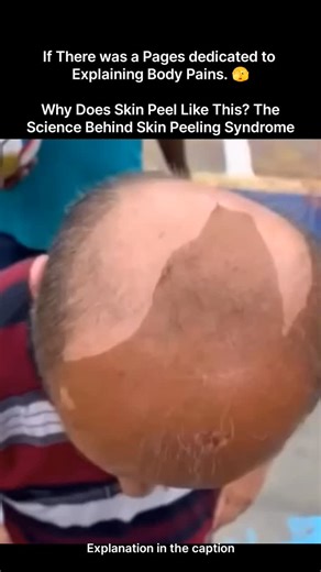 Explaining Biology on Instagram: "Skin peeling syndrome is a rare condition where the outermost layer of the skin separates and peels off easily, often without pain or bleeding. This happens due to a defect in the proteins that normally hold skin cells tightly together. In many cases, the problem lies in abnormal keratin or corneodesmosomes, which are responsible for maintaining skin integrity. As a result, the stratum corneum loses its strength and detaches in sheets, especially after friction,