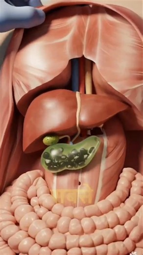 Laproscopic Cholecystectomy