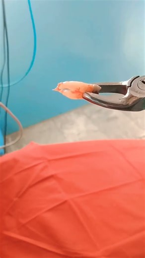 extraction upper 1st premolar 😱 #youtubeshorts #ytshorts #shorts #viralshorts #dentist