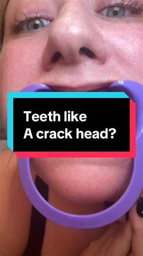 Didn't expect this!!! #crackhead #teeth #teethwhitening #yellowteeth #teethwhiteninghack @CEELIKE Europe
