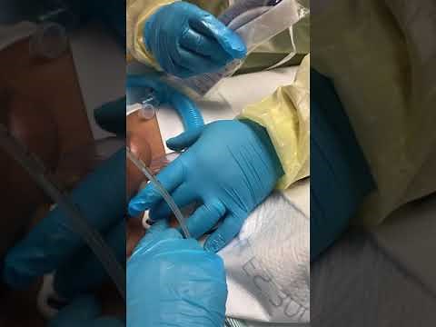 Bedside tracheostomy live