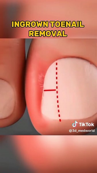 Ingrown toenail removal surgery #IngrownToenail #ToenailRemoval #NailSurgery #FootCare #Podiatry 2 #Toenail Surgery #FootHealth 4 #IngrownToenail Removal #HealthyFeet #Foot Surgery #PainRelief #ToeCare 2 #Podiatric Surgery #NailCare #HealingFeet