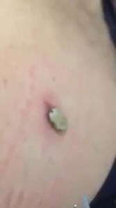 1.2M views · 1.4K reactions | Tick Removal Video | Pimple Popping, Cyst and Blackhead | Facebook