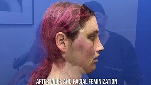 FFS and VFS 6 Day Post Op