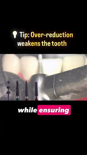 Step-by-step anterior crown preparation using the correct burs |Dr.Dentique-hub