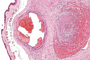 Fibrin - Alchetron, The Free Social Encyclopedia