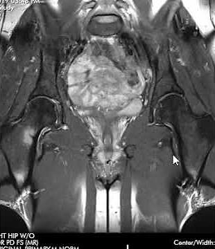 Stress fracture femoral neck