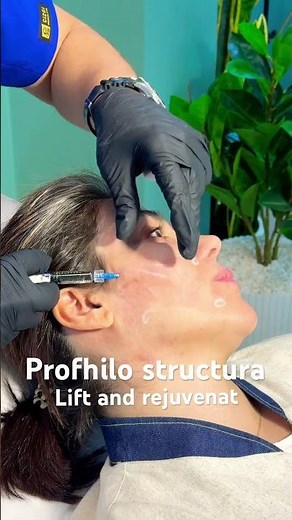 In this video I perform a full face profhilo structura treatment, injection is on periost