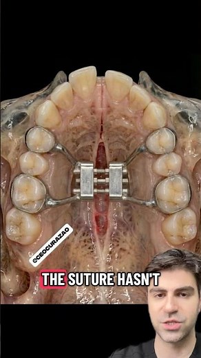 Palate Expanders SPLIT Your Bones?