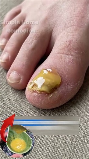 💅 Nail Fungus Troubles! ✨ Start caring for your nails today and enjoy a cleaner, healthier look 🌿�