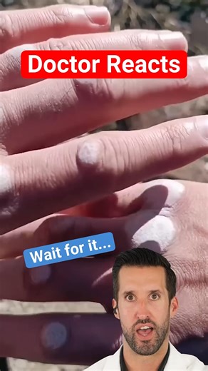 48K views · 300 reactions | Doctor Reacts to Hand Calluses | Doctor ER | Facebook