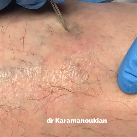 Draining clot from a thrombosed superficial vein in the leg. #thrombophlebitis #bloodclot @veintreatmentcenter on IG @sclerotherapyvids on IG (my second channel) www.VeinsVeinsVeins.com @BuffaloVeins on #YouTube VeinsVeinsVeins.com on #TikTok | Vein Treatment Center
