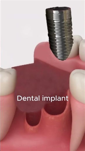 Tooth fracture | split tooth | Dental Implant | 3D animation #3danimation