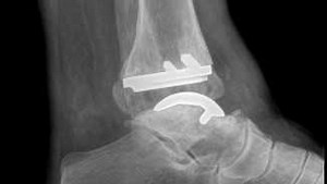Total ankle replacement surgery offers pain relief for Boston patients