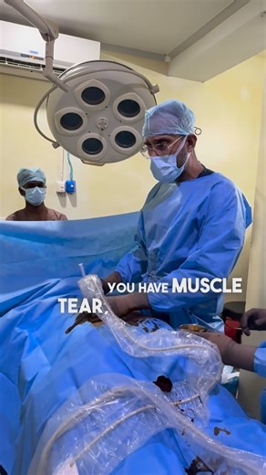 Dr Santhosh Jacob MBBS,DNB,MCh,DABRM on Instagram: "ADVANCE IN SPORTS INJURY CARE: MRI + US-Guided Intralesional PRP for Muscle Tears Not every “muscle pull” is the same. If the tear can be seen and targeted, we can treat it more precisely. Who is a candidate • MRI-confirmed tear with a clearly defined location (commonly grade 2 / partial tears). • The tear/hematoma must be localizable on ultrasound in real time (so the needle can be placed inside the lesion). How it’s done (the precision part) 