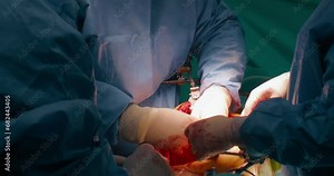 Close up of cancer surgery. Team of skilled surgeons remove cancer cells from stomach with modern laser technology,cut out tumor from patient body,working on open wound.Handheld documentary style shot