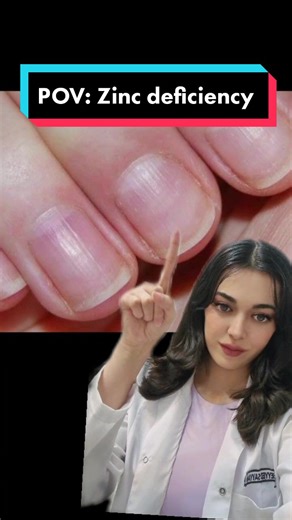 This is called Onychorrhexis. Our nails naturally develop slight vertical ridges as we age. However, severe and raised ridges can be a sign of Zinc and Iron deficiency anemia, and nutritional deficiencies, such as a lack of vitamin A, vitamin B, vitamin B12, or keratin can result in fingernail ridges. Hormonal changes, and dry and eczema skin can also cause ridges to appear. These lines aren't dangerous. skin conditions. #nails #nailhealth #irondeficiency #zinc #zincdeficiency #skinhealth #onych