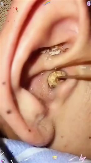 👂😊Pro 6-pc ear cleaning set, ligtas at komportable sa paglilinis ng tainga.