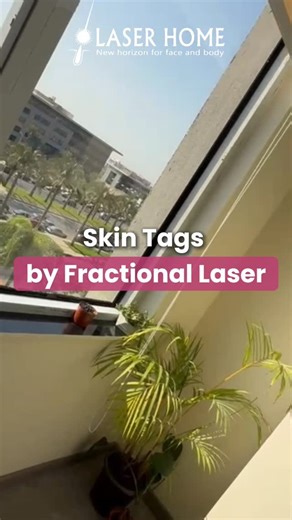  Fractional laser: the gentle way to remove skin tags and reveal flawless skin. #skintagsremoval #laserhomeclinic | Laser Home | Facebook