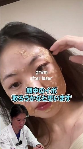 [DuoActive] Use your vacation time to remove facial warts and moles with a laser! Dermatologist D...