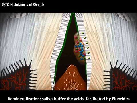 Dental Caries (Histopathology)