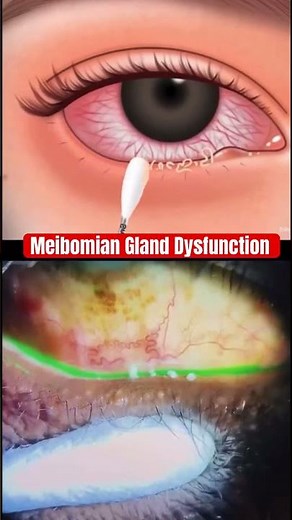 Watch This! Pus Strings From Eyelid Glands? 😳 | Meibomian Gland Dysfunction Explained!