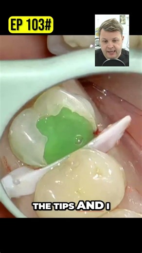 Dental Bonding Fixing Bleeding & Rubber Dam Issues
