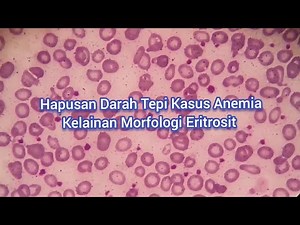 Kelainan Eritrosit Ukuran Warna dan bentuk | Hapusan Darah Tepi