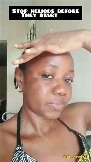 Python Oil For Keliod Prone Skin After Injury