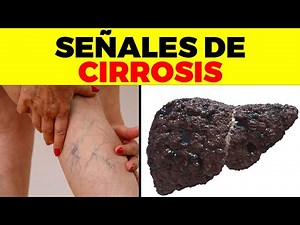 ASI EMPIEZA la CIRROSIS y nadie te lo dice, signos y síntomas de cirrosis