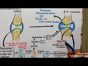 Rheumatoid arthritis: aetiology, pathophysiology, symptoms and treatment in hindi