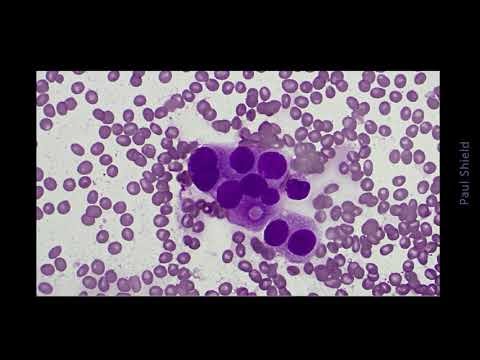 LN FNA Unknown CASE 6
