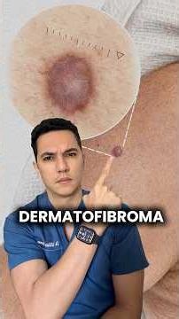 Dermatofibroma: a common benign skin tumor. #dermatology #dermatologist #dermatologistwilliamguer...