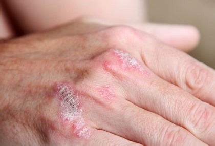 乾癬好發秋冬！醫師解析2大典型症狀與4種易惡化情況-台視新聞網