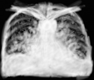Interprétation d’une radiographie thoracique en urgence – 3 – opacités pulmonaires multiples