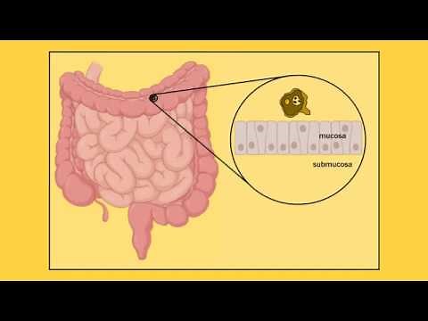Entamoeba histolytica