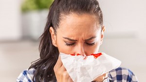 Sangrar por la nariz hasta llenar un barreño pequeño: así es el síndrome de Rendu Osler Weber