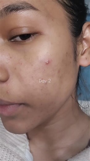 This is how I treat my pustule acne in 3 days 📅 #acnetreatment #acnejourney