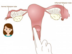 Cervical motion tenderness is non specific for pelvic pathology (e.g., ectopic pregnancy, pelvic inflammatory disease or acute appendicitis). #FRCEM_Medicine_Keys | Medicine Keys for Internal Medicine