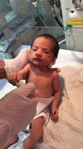 NICU Newborn Grasp Reflex Explained | Palmar Grasp Reflex in Babies | Neonatal Assessment