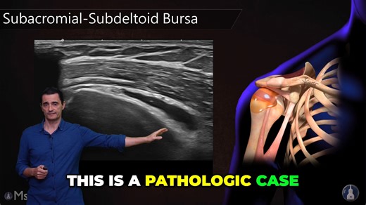 Practical MSK ultrasound training designed for real clinical practice. Until Monday, all MSKFreak courses are 15% off. This video clip is taken from a complete lesson inside the platform, where each region is explained step-by-step with anatomy, probe positioning, and real scan examples. If you find this useful, the full course will accelerate your MSK ultrasound skills. 👉 Use code BLACK15 at MSKFreak.com ⏳ Offer ends Monday #mskultrasound #ultrasoundeducation #sportsmedicine #radiology #physio