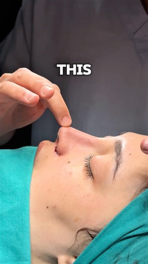 The Truth About Thick Skin Rhinoplasty #thickskin #rhinoplasty #nosejobbeforeandafter #nose #surgery