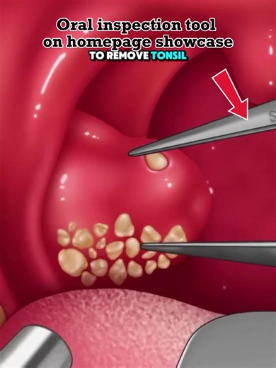 Understanding Tonsil Stones: Causes and Solutions