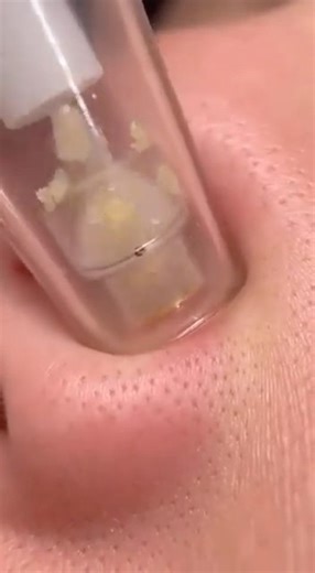 Watch My Nose Pores Get DEEP Cleaned! Satisfying Blackhead & Whitehead Extraction