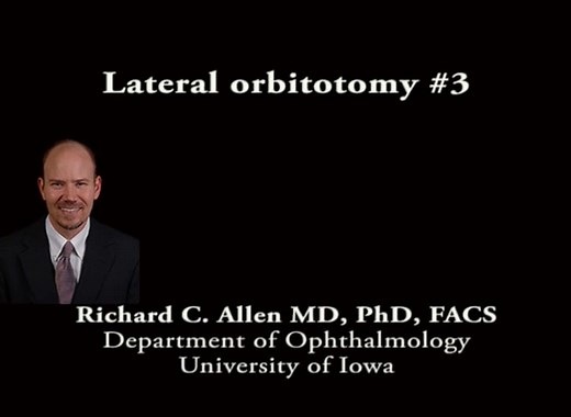 Lateral orbitotomy 3