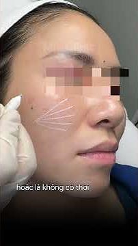 Tách đáy sẹo bằng kim Cannula #miaclinic