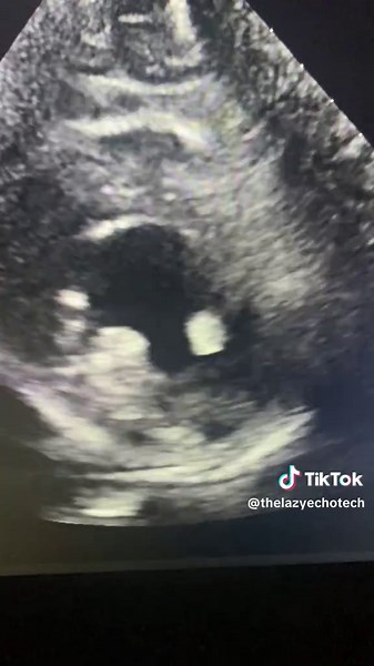 Understanding Segmental Wall Motion Abnormality in Echocardiography