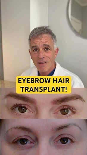Eyebrow Hair Transplant Procedure