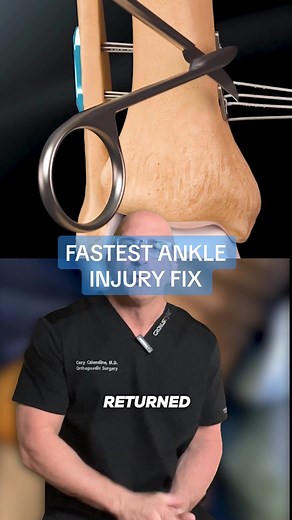 Fastest Ankle Sprain Fix 🏈 Tightrope Surgical Repair for High Ankle Sprain Injuries - Tightrope surgical repair is a procedure gaining popularity in orthopedics and the sports medicine community. The Tightrope ankle repair procedure is used to treat high-ankle sprains (injuries to the ligamentous complex bridging the two leg bones, tibia and fibula, specifically where they articulate at the ankle joint). The procedure involves anatomically reducing the gap between the bones, drilling across the