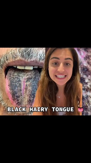 Understanding Black Hairy Tongue: Causes & Treatment Explained